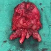غده پروستات مبتلا به سرطان همراه با کیسه های منی دو طرف که بطور کامل برداشته شده است(رادیکال پروستاتکتومی)