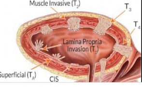 شکل شماتیک تومورهای سطحی و عمقی مثانه