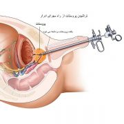 جراحی سرطان پروستات