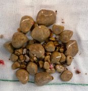 سنگ مثانه