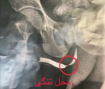 جراحی استنت تنگی مجرا